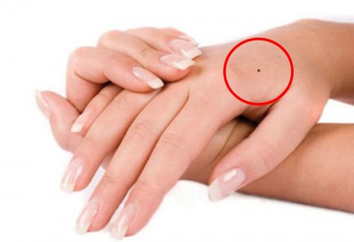 Nốt ruồi ở mu bàn tay phải nữ giới