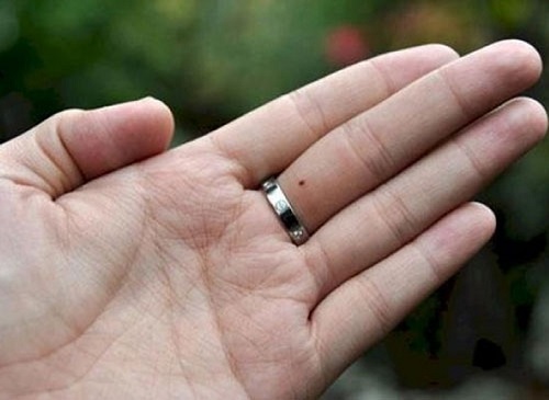 Nốt ruồi ở ngón tay giữa